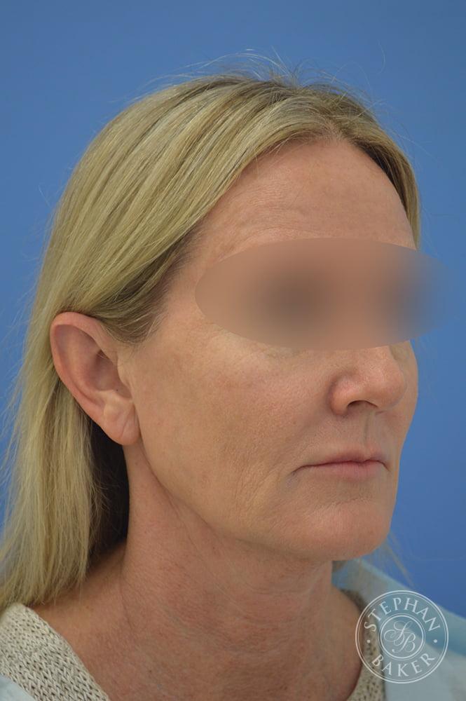 Face & Neck Lift Before & After Image