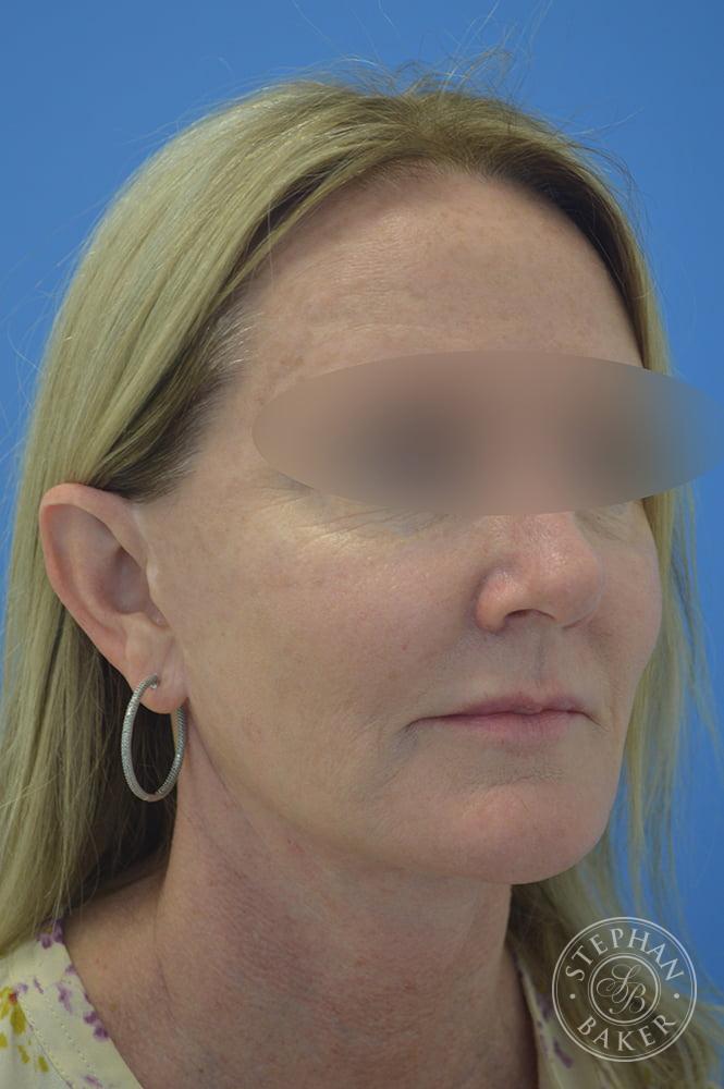 Face & Neck Lift Before & After Image