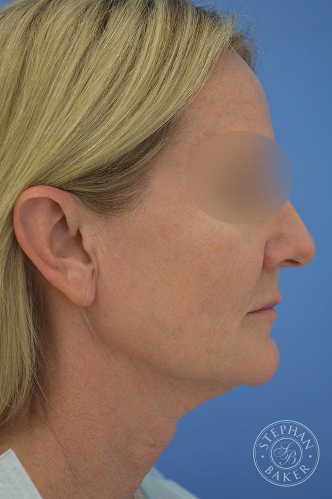 Face & Neck Lift Before & After Image