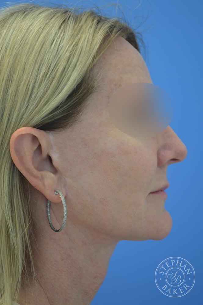 Face & Neck Lift Before & After Image